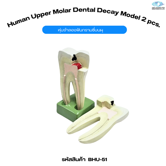 หุ่นจำลองฟันกรามซี่บนผุ  Human Upper Molar Dental Decay Model 2 pcs